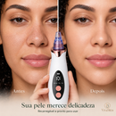 Removedor e Aspirador Facial de Poros 5 Intensidades com Ponteiras - Removedor de Cravos